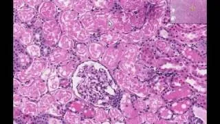 Histopathology Kidney --Acute tubular necrosis