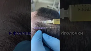 Плазмотерапия головы - от выпадения волос! www.medicris.ru #трихолог #выпадениеволос #shorts