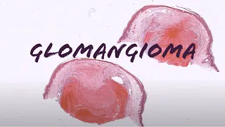 Glomangioma/Glomuvenous Malformation (glomus tumor with lots of vessels) pathology dermatology