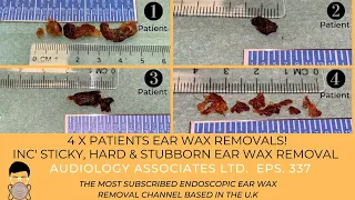 4 X PATIENTS EAR WAX REMOVALS! INC STICKY, HARD & STUBBORN EAR WAX REMOVALS - EP 337