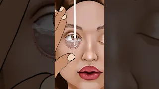 #asmr Eye Stone Removal & Eyelid Sebum Extrusion Meibomian Gland Cleaning #animation #beauty