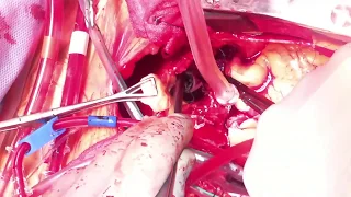 Acute Type A Aortic Dissection Repair