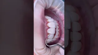 ASMR DENTAL VENEERS  #shorts #shortsvideo #shortsviral #shortsfeed #asmr #asmrforsleep