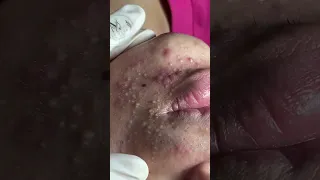 Wow !!! Acne under skin - Acne treatment Mai Ngoc Da Nang #acnetreatment #điềutrịmụn #maingoc