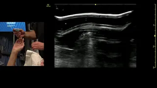 Upper Extremity DVT POCUS