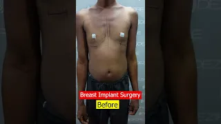 Silicone Breast Implant | Breast implant cost #shortvideo