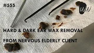 555 - Hard & Dark Ear Wax Removal from Nervous Elderly Client