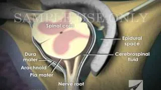 Loss of Pressure Epidural Injection