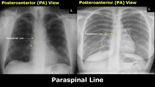 Normal Chest X-Ray Labelled Anatomy PA View Part 2: CXR Interpretation | Mediastinum Radiography