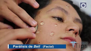 FisioTips  Parálisis Facial