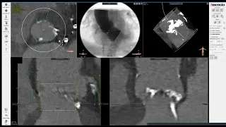 3Mensio CT pre-case planning: TAVR in Bicuspid Valve, Part 1