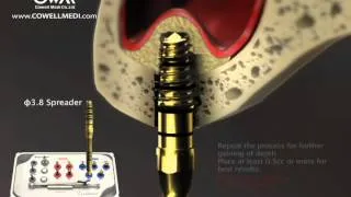 Sinus Lift Kit Manual Animation