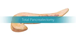 Total Pancreatectomy: How the Procedure Is Performed