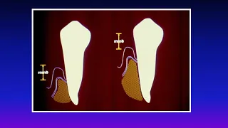 Tooth supported overdentures and remaining roots by Prof Dr. Zainab Elshorbagy