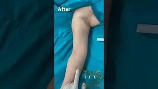 Scarless Armlift by Dr.TAS