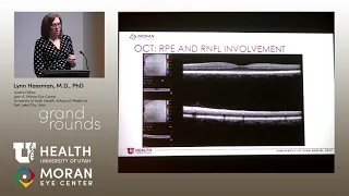 Multifocal Choroiditis