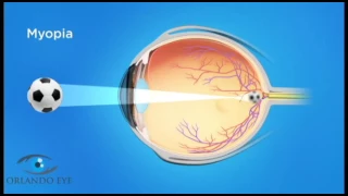 Refractive Errors