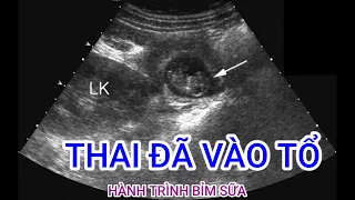 8 dấu hiệu nhận biết thai đã làm tổ trong tử cung || Hành trình bỉm sữa