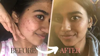 How i cleared my acne by reducing pitta dosha| NO Sponsor products | Personal Experience