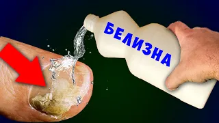 Как я уничтожил ГРИБОК ногтя Обычной БЕЛИЗНОЙ! Грибок боится этого больше всего