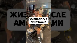 Жизнь после ампутации. Часть 1