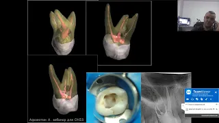 Вебинар №3 - Частная анатомия корневых каналов.