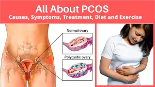 How to Manage PCOS: Causes, Symptoms, and Treatment Options