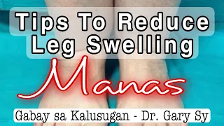 Tips To Reduce Leg Swelling - Dr. Gary Sy