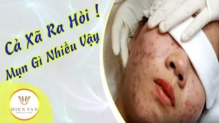 Cách điều trị mụn bọc, mụn viêm hiệu quả ( do dùng thuốc rượu, thuốc bắc ). bài 124