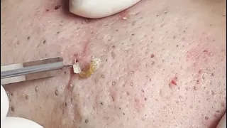 SATISFYING VIDEO WITH BLACKHEAD REMOVAL