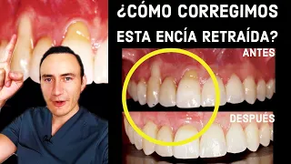 ¿Cómo se corrige esta encía retraída? Antes y después de la cirugía. #shorts