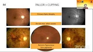 AIOC2021-GP126-Topic-Dr.Medha Nitin-Prabhudesai Optic disc assessment  Not cup disc ratio alone