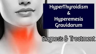 Hyperthyroidism & Hyperemesis Gravidarum: Treatment | Antai Hospital