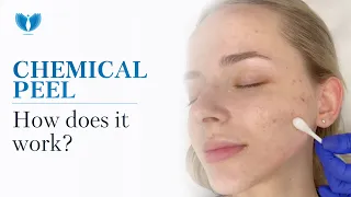 Chemical Peel - Chemical Peeling Treatment | Acne Solution | Chemical Peel for Acne and Acne Scars