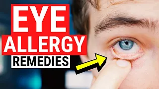 Eye Allergy Remedies - Tips for Itchy and Watery Eyes