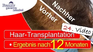 Happy! Mega-End-Ergebnis Vorher / Nachher - Ein Jahr nach Haartransplantation in der Türkei (#24)