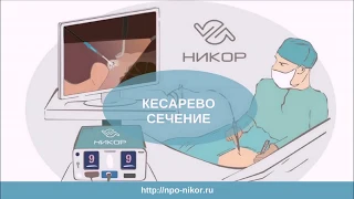 Кесарево сечение