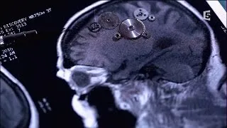Accidents vasculaires cérébraux, les bons réflexes - Enquête de santé le documentaire