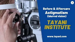 Before & After Astigmatism (Blurred Vision) Diagnosis | Tayani Institute