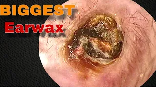 BIGGEST Earwax, Difficult Removal EP9 | Doctor Anh