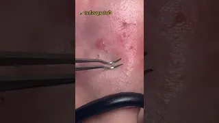 Ultimate Blackhead Removal & Pimple Popping 🔴 69