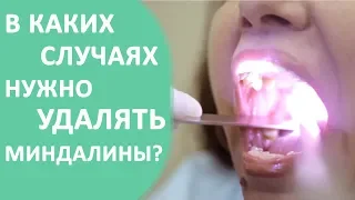 Удаление миндалин ✂ В каких случаях требуется удаление миндалин.