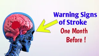 10 warning signs of stroke|Stroke a week before it happens|Unbelievable signs|Symptoms of stroke