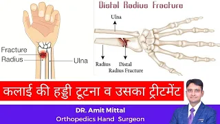 Distal Radius Fracture | wrist fractures explained in simple hindi | कलाई की हड्डी टूटना
