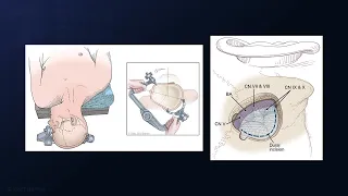 Arterial Transposition with Aneurysm Clip for Microvascular Decompression of Trigeminal Neuralgia