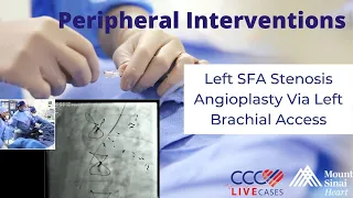 Left SFA Stenosis Angioplasty Via Left Brachial Access – Peripheral Live September 2017