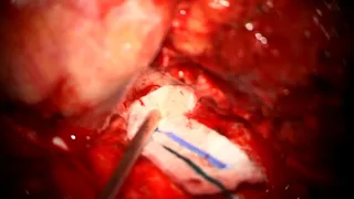 HAKUBA TECHNIQUE to expose the lateral cavernous sinus wall. Dr. Gmaan Alzhrani