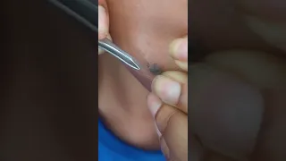 Extraction of hair from mole Extraction of facial hair