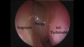 Nasal Polyp Removal in the Operating Room