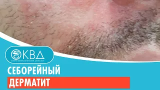 😐 Себорейный дерматит. Клинический случай №201